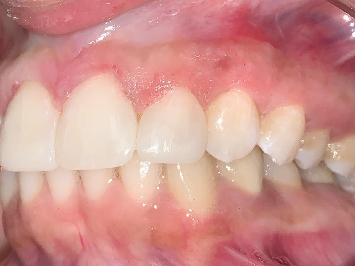 Gaps beside the front teeth after treatment