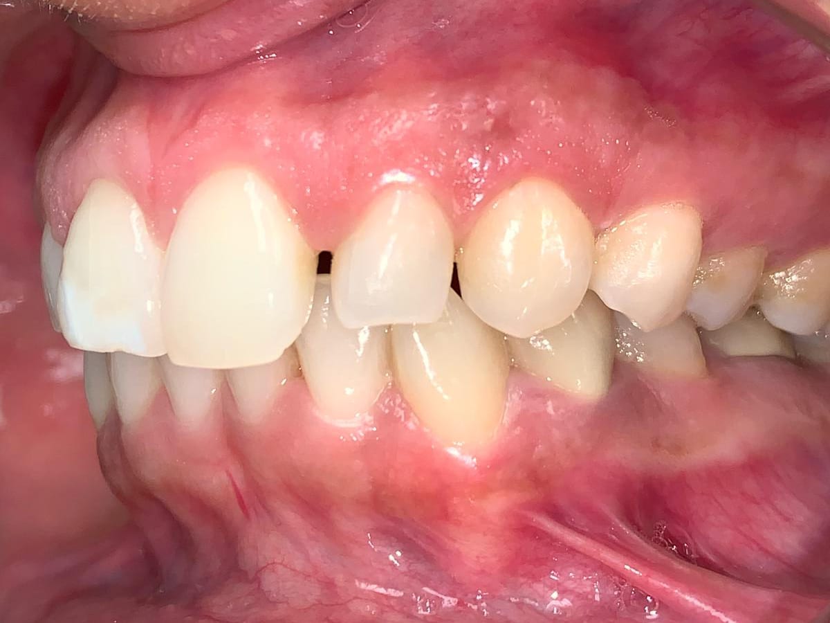 Gaps beside the front teeth before treatment