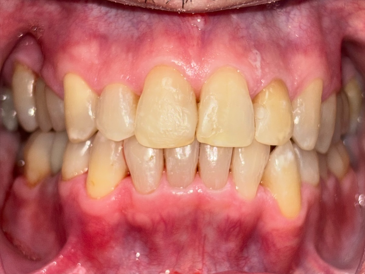 Crowded front teeth after treatment