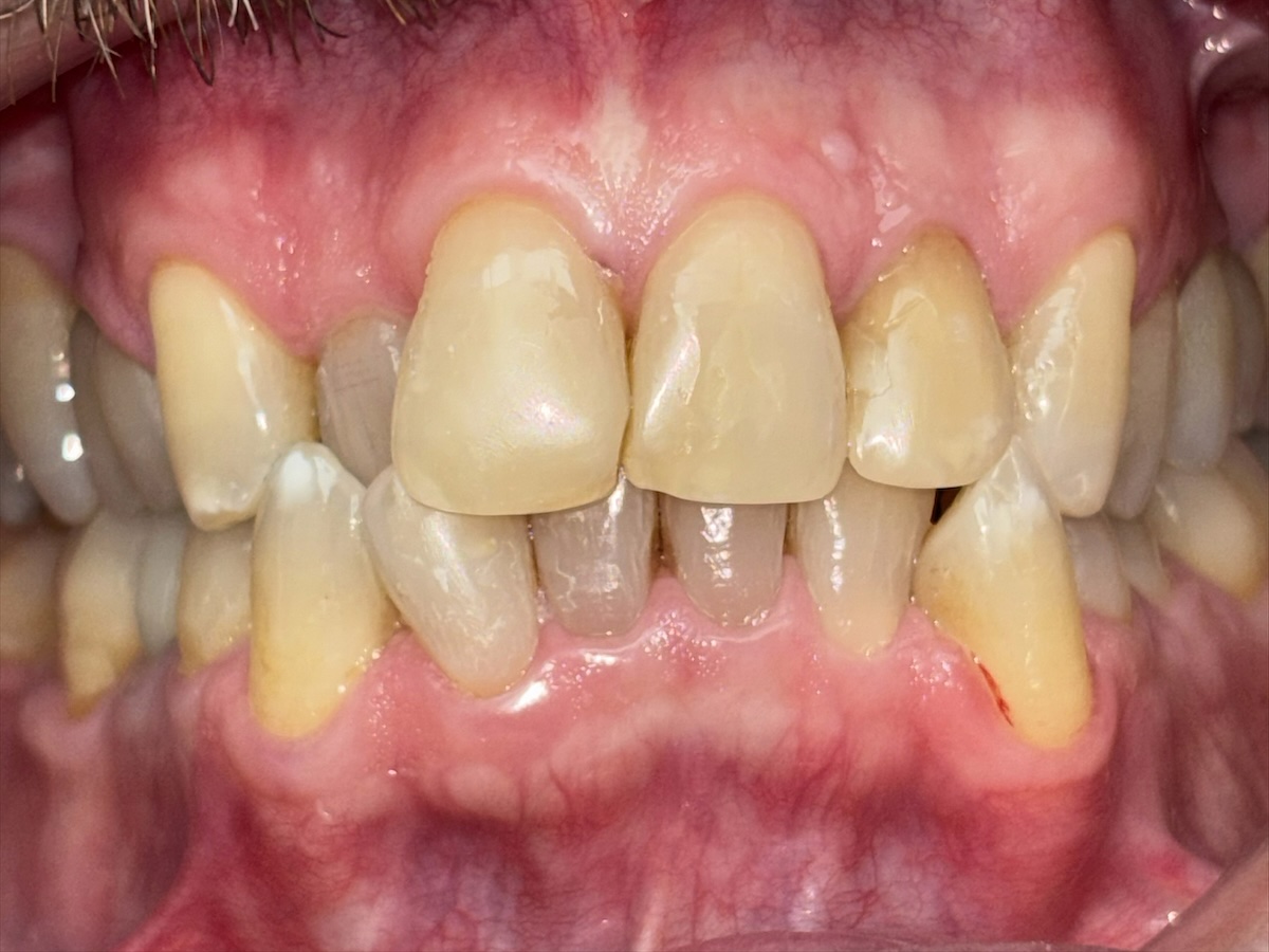 Crowded front teeth before treatment